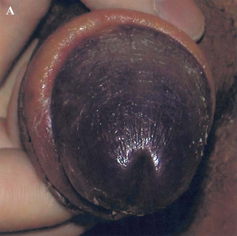 Tip Of Penis Blue 68