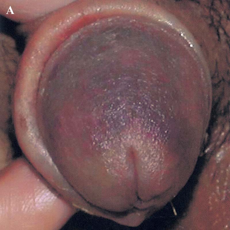 Good wound healing and nearnormal color of glans penis anteroposterior 