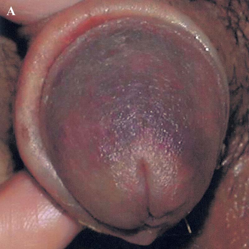 Penis Head Color 40